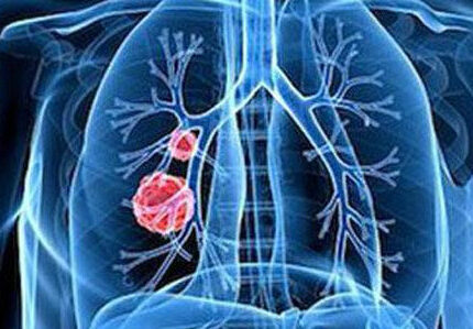 肺癌患者的肺康复训练