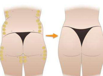 臀部吸脂会有丰臀的效果吗？