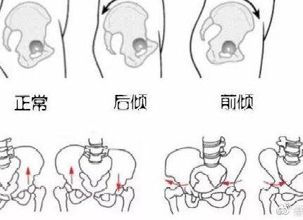 骨盆变形除了会膝盖外屈还会怎样？