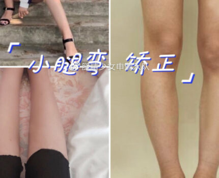 直腿术矫正O型腿，是微创矫正腿型手术哦