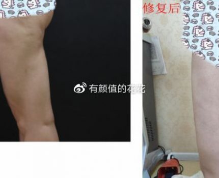 北京哪个医生吸脂修复好?擅长脂肪修复的医生