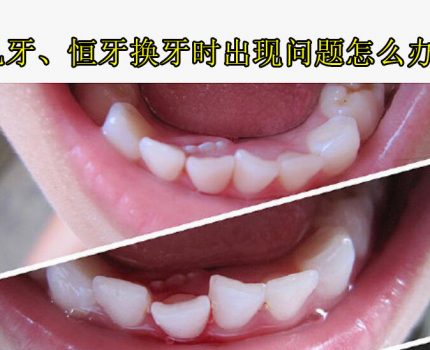 乳牙没掉恒牙长出来影响换牙吗？儿童牙齿问题爸妈别忽视！