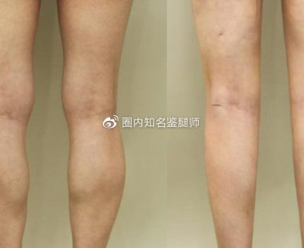 杭州瘦小腿+O型腿矫正术后分享