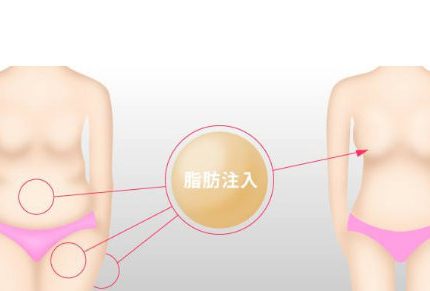 做自体脂肪填充隆胸后，会出现硬块结节吗？怎么避免？