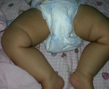 宝宝大腿皮纹不对称，是髋关节发育不良？可能没你想的那么严重